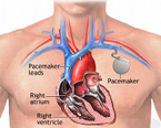 Pinecrest pacemaker