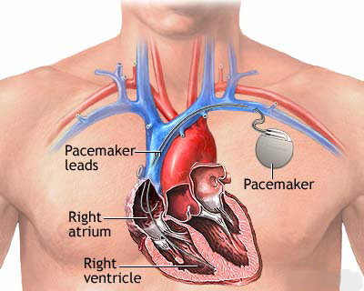 pacemaker surgery